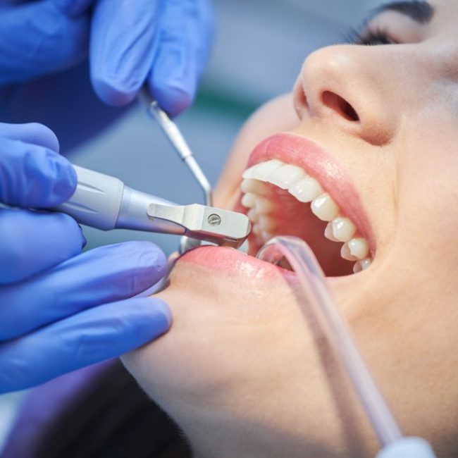 Teeth Whitening - Cosmetic Dentistry